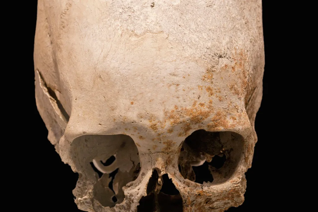 Trepanation