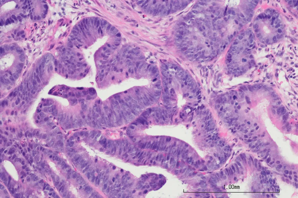 Colon Cancer