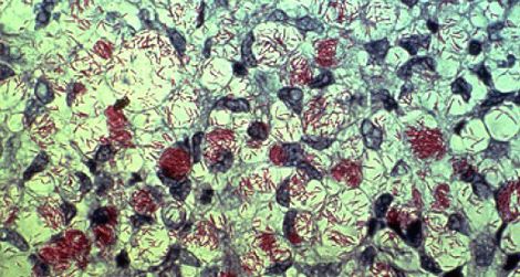 Mycobacterium leprae, in red.