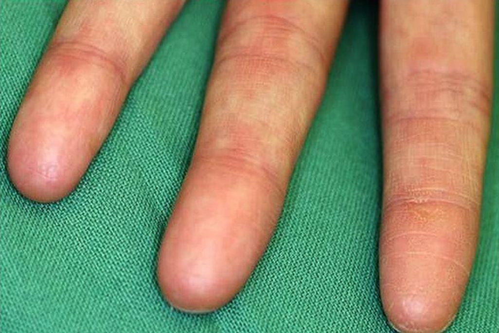 adermatoglyphia.jpg
