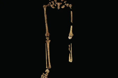The uncovered skeleton shows where the lower left leg was amputated at the tibia and fibula.