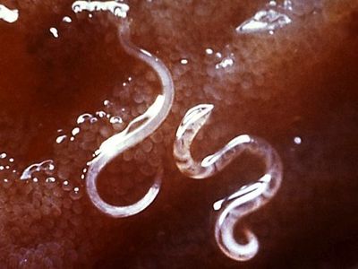Parasitic hookworms in a person’s intestinal lining.