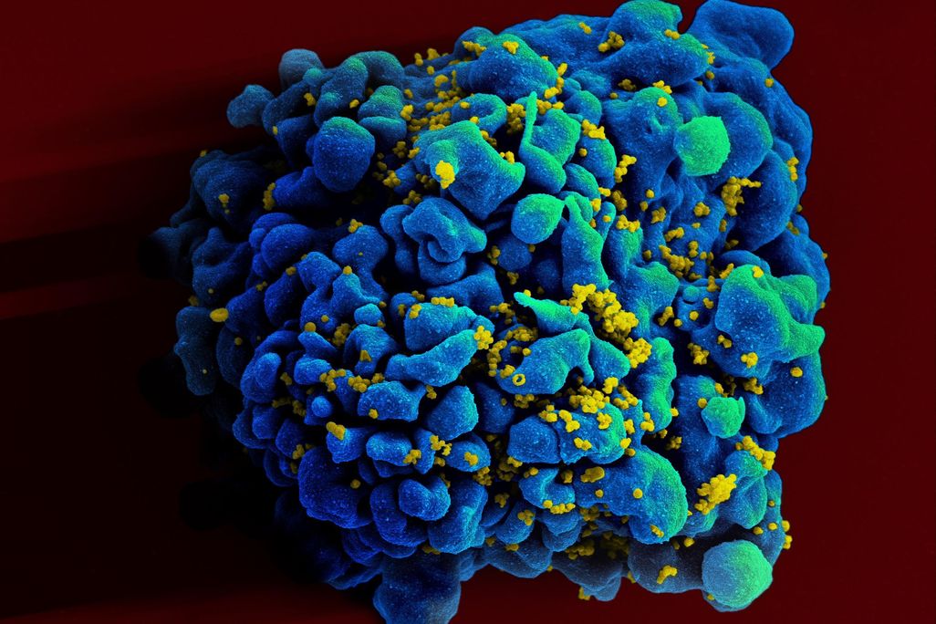 An image of a T-cell infected with HIV taken with an electron microscope. The T-cell looks like a blue blob and it's against a red background. There are tiny yellow particles surrounding the blue structure. These are HIV virons.