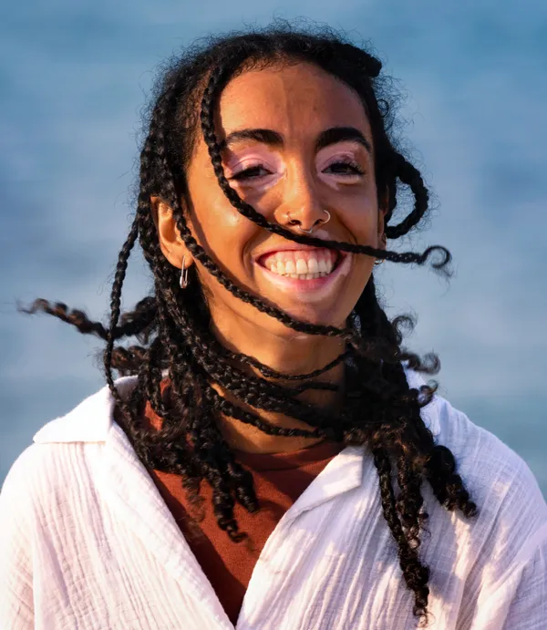 Vitiligo girl thumbnail