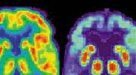 The brain scan on right shows Alzheimer’s damage.