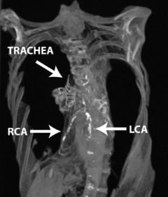 Calcification in the right (RCA) and left (LCA) coronary arteries appears white in this CT scan