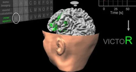 The system detects patients’ thoughts via an fMRI machine and translates these into specific letters.