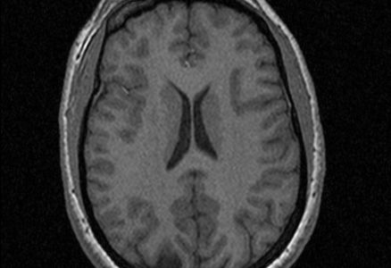 A functional magnetic resonance image of a brain.