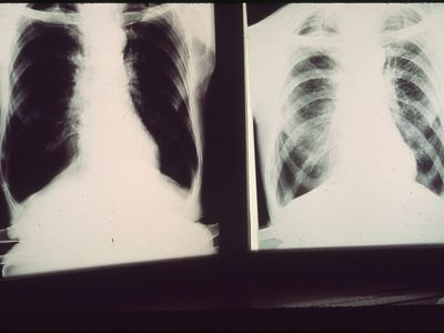 Black lung x-rays from a patient in Birmingham, Alabama, 1972