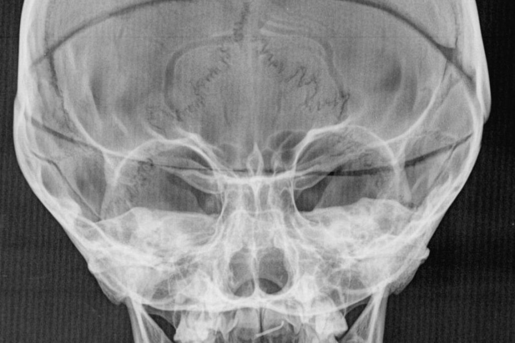 Five-year-old don Filippino’s abnormally swollen skull.