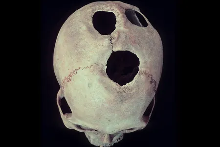 An Inca skull from the Cuzco region of Peru, showing four healed trepanations. The new review focuses on the practice in ancient China.
