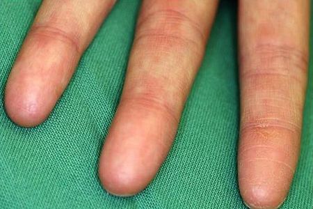 The finger pads of a person with adermatoglyphia are entirely smooth.