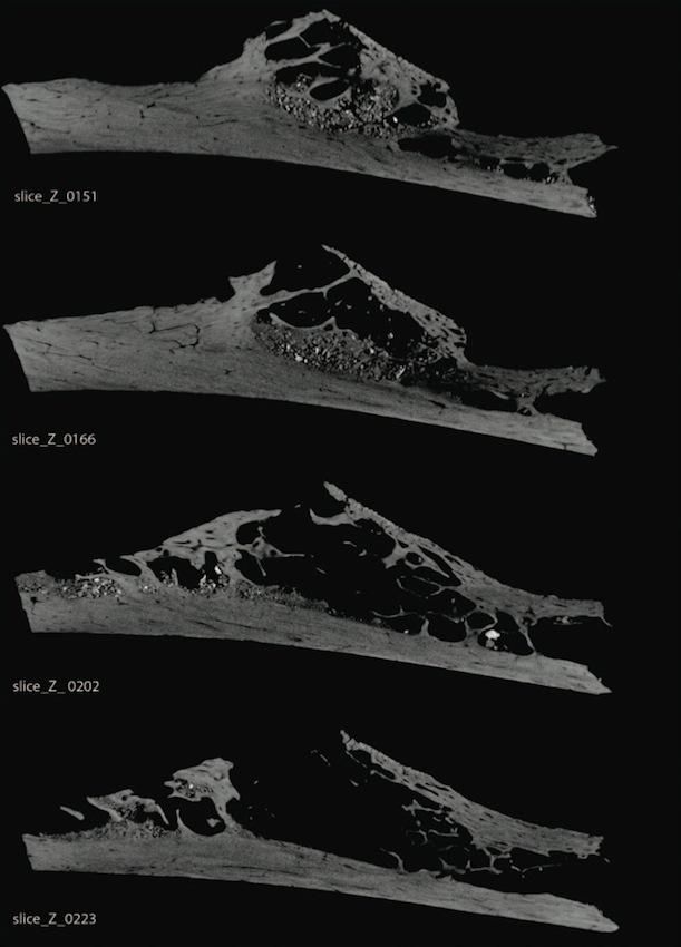 CT scans of the rib bone show the cavity left behind by the tumor.