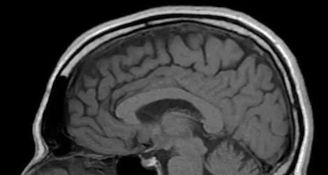 Researchers have found neurological abnormalities