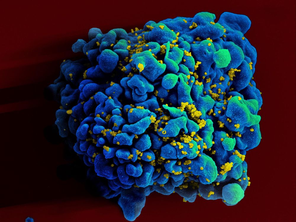 An image of a T-cell infected with HIV taken with an electron microscope. The T-cell looks like a blue blob and it's against a red background. There are tiny yellow particles surrounding the blue structure. These are HIV virons.   