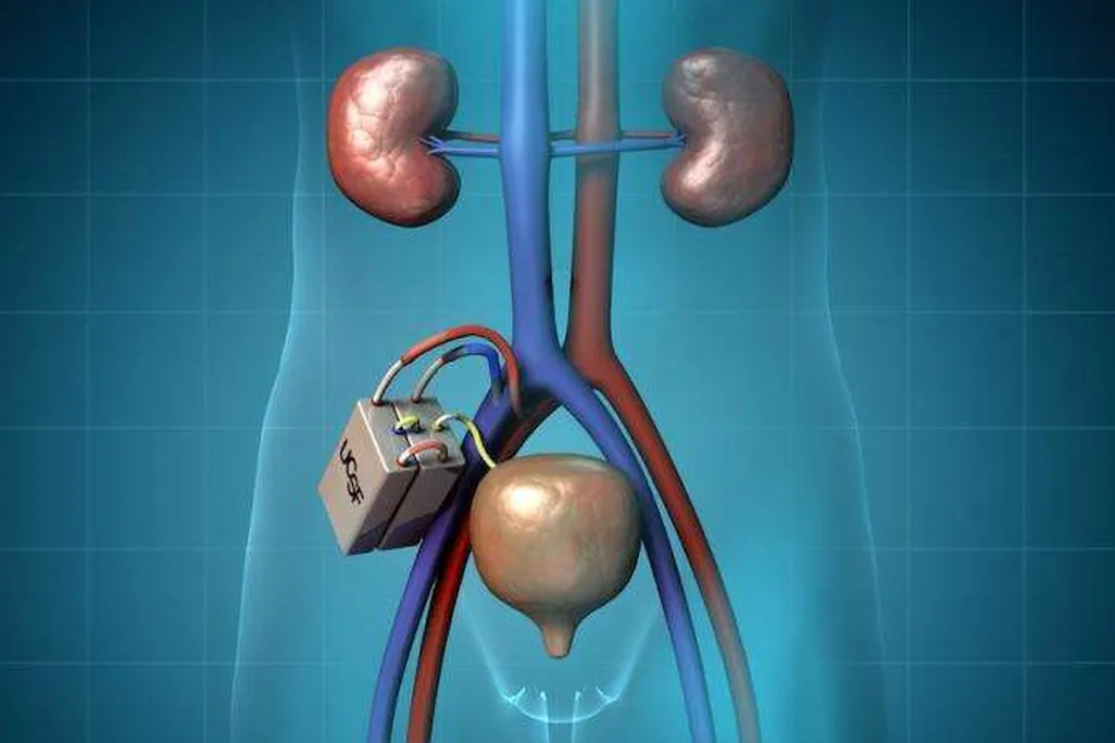 A digital illustration of what the bioartifical kidney device looks like inside the body