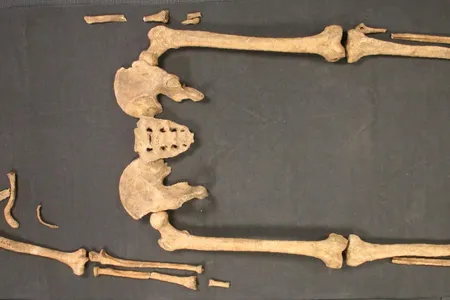 This 1,500 year old skeleton from the Anglo-Saxon town of Great Chesterford was a young man who had leprosy