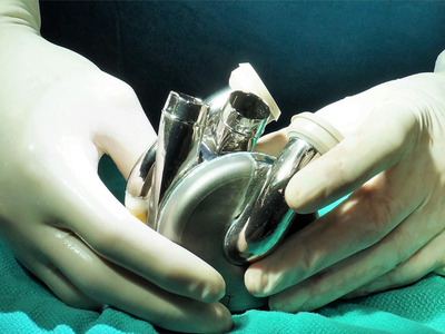 Developed by Australian biomedical engineer Daniel Timms, the titanium heart device is being used as a stopgap until patients can undergo transplant surgery with a donor heart.