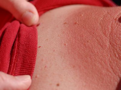 Researchers recently pinpointed the molecule responsible for the searing pain of a sunburn—and may have found a new way of eliminating it entirely.