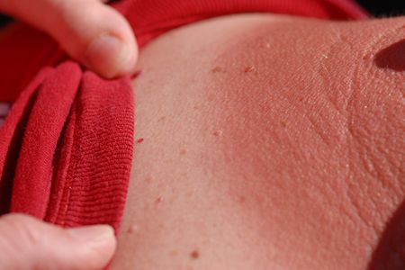 Researchers recently pinpointed the molecule responsible for the searing pain of a sunburn—and may have found a new way of eliminating it entirely.
