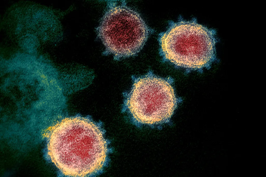 An electron microscope image of of SARS-CoV-2