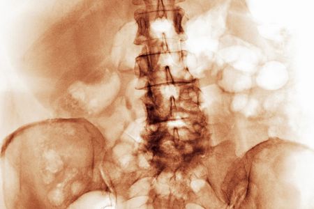 This man's spine wasn't cut by a knife, but rather is degenerating from arthritis. 
