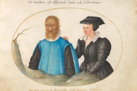 An artist's portrayal of the so-called "werewolf syndrome" circa 1575-1580.