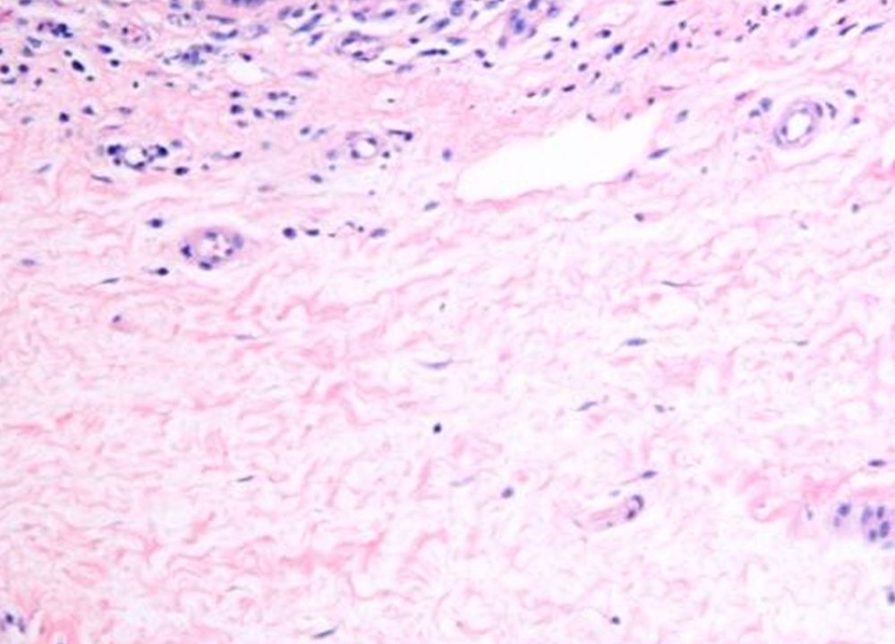 Dermal interstitium