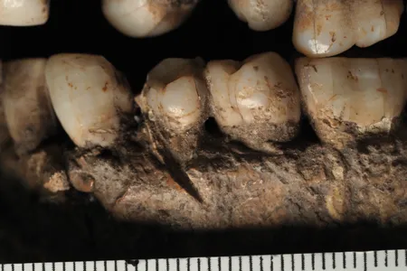 Researchers found evidence that the wound healed.