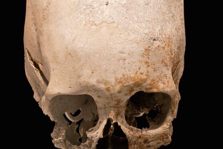 A skull shows evidence of trepanation, an early form of neurosurgery that called for a hole cut into the skull.