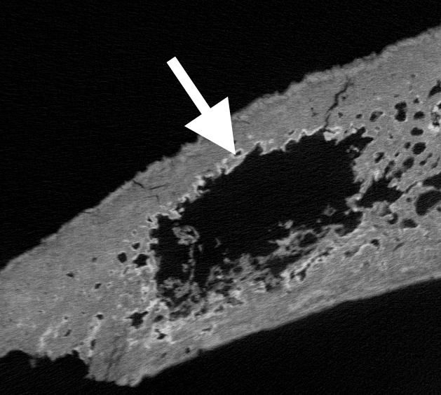 A white arrow points to metastasis hidden within a medieval skull