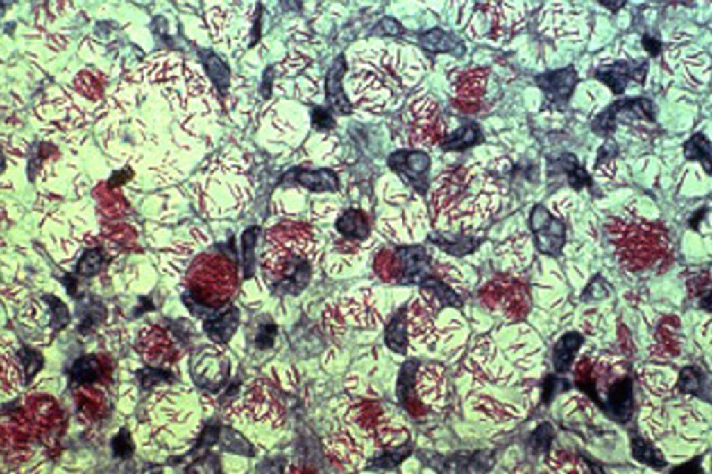Mycobacterium leprae, in red.