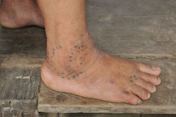 Medicinal joint tattoo of the Kayan