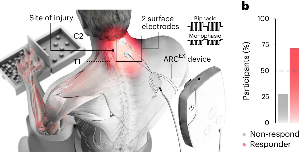 An artist's rendering shows where Arc-Ex is placed on a person's neck to stimulate electric pulses on their spinal cord.
