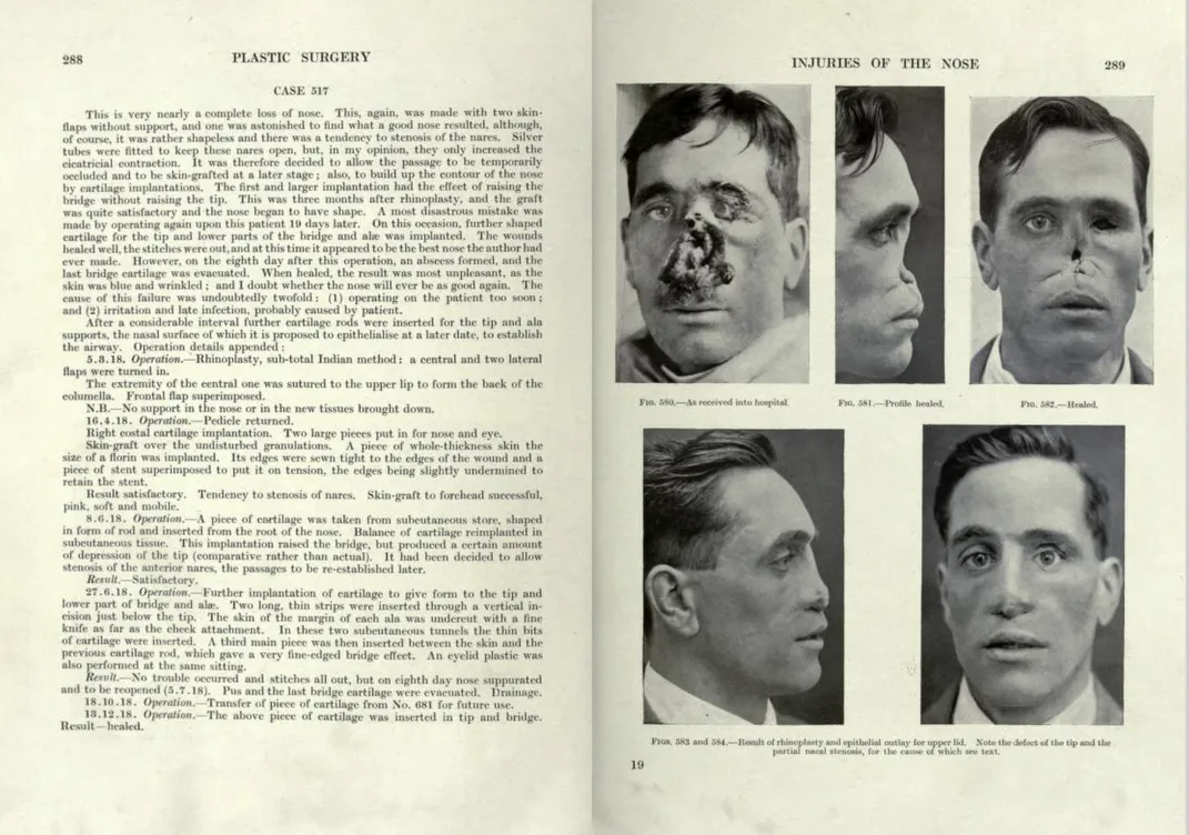 A case study from Gillies' Plastic Surgery of the Face​​​​​​​
