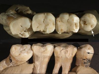 The Neanderthal teeth, including the impacted molar