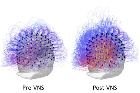 A comparison of the man's brain activity before and after he had vagus nerve stimulation.