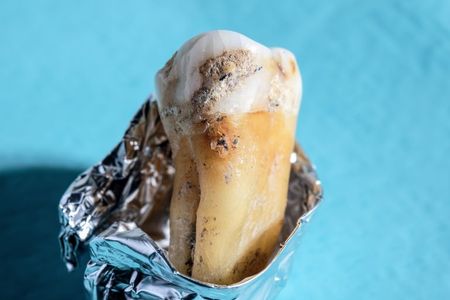 A close-up of fossilized plaque on an ancient human tooth. 