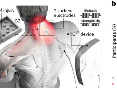 Electrodes, placed above and below the injury, provide electric stimulation during rehabilitation, in this artist&#39;s rendering of the new Arc-Ex device.
