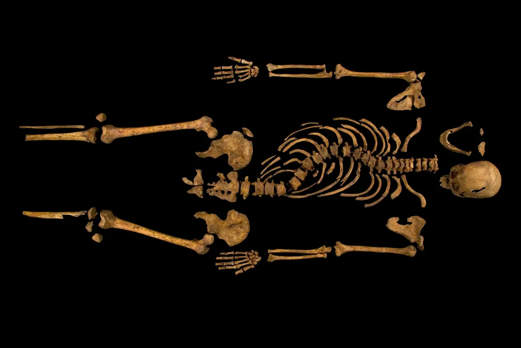 The complete skeleton shows the curve of Richard's spine.