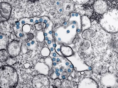 Microscope image of an isolate from the first U.S. case of Covid-19. Viral particles are visible in blue. 