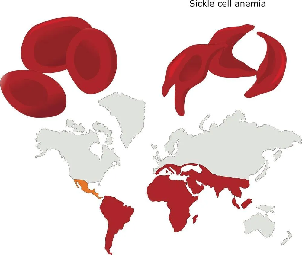 Sickle Cell and Malaria