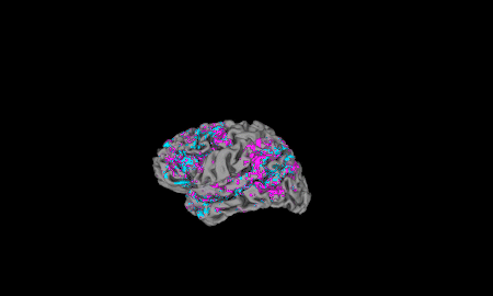 A spinning 3D view of one person&#39;s cerebral cortex. Pink indicates above average activity and blue shows below average activity.