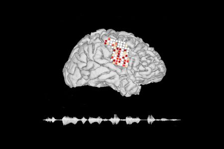 Using a brain implant with a series of electrodes, scientists can read neurological signals and translate the brain activity into spoken language. 