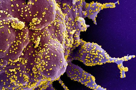 Electron microscope image of a human cell (purple) heavily infected with SARS-CoV-2 virus particles (yellow)