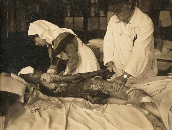 A World War 1 soldier being treated for mustard gas.