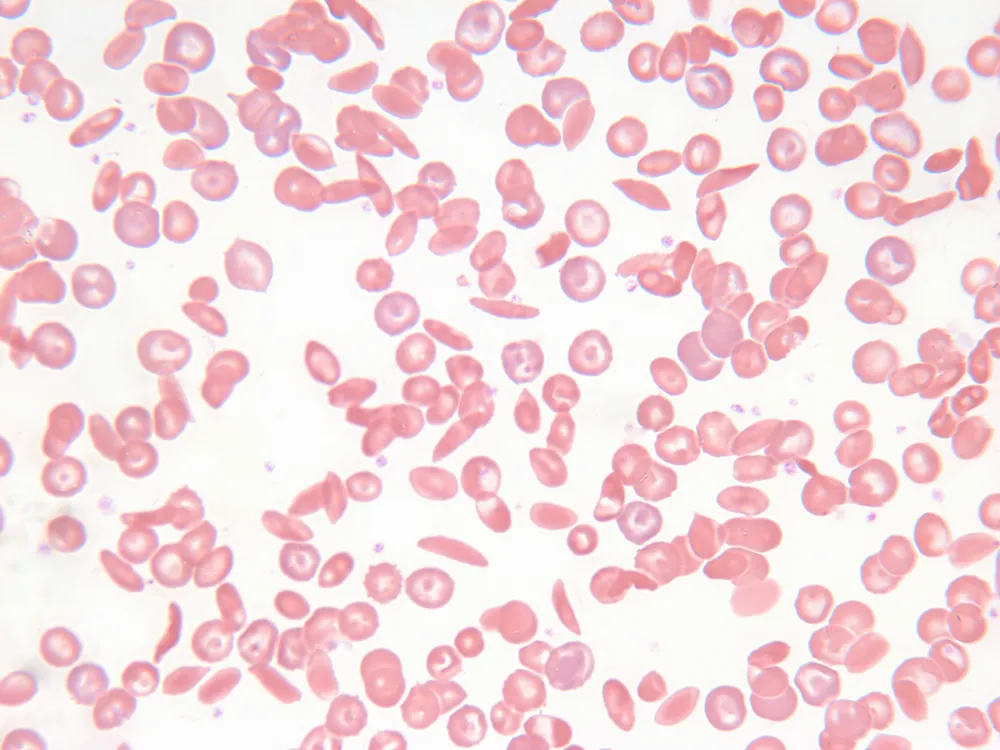 A zoomed in view of both normal, round red blood cells, and crescent-shaped sickle cells