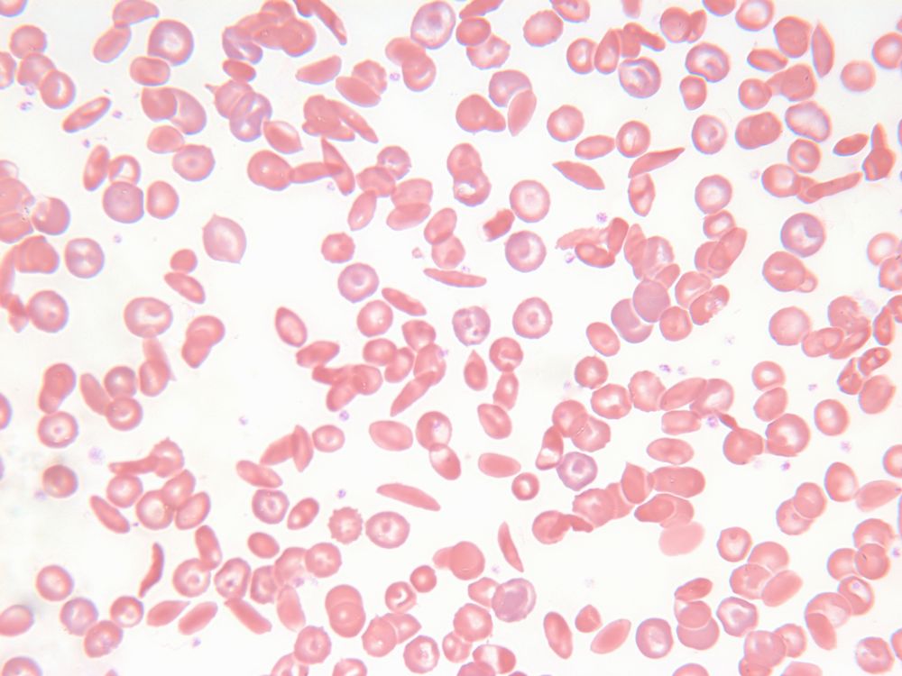 What is the difference between sickle cells and healthy RBCs?