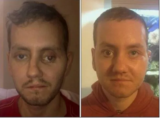 How 3D Printing Helped Repair This Man's Face