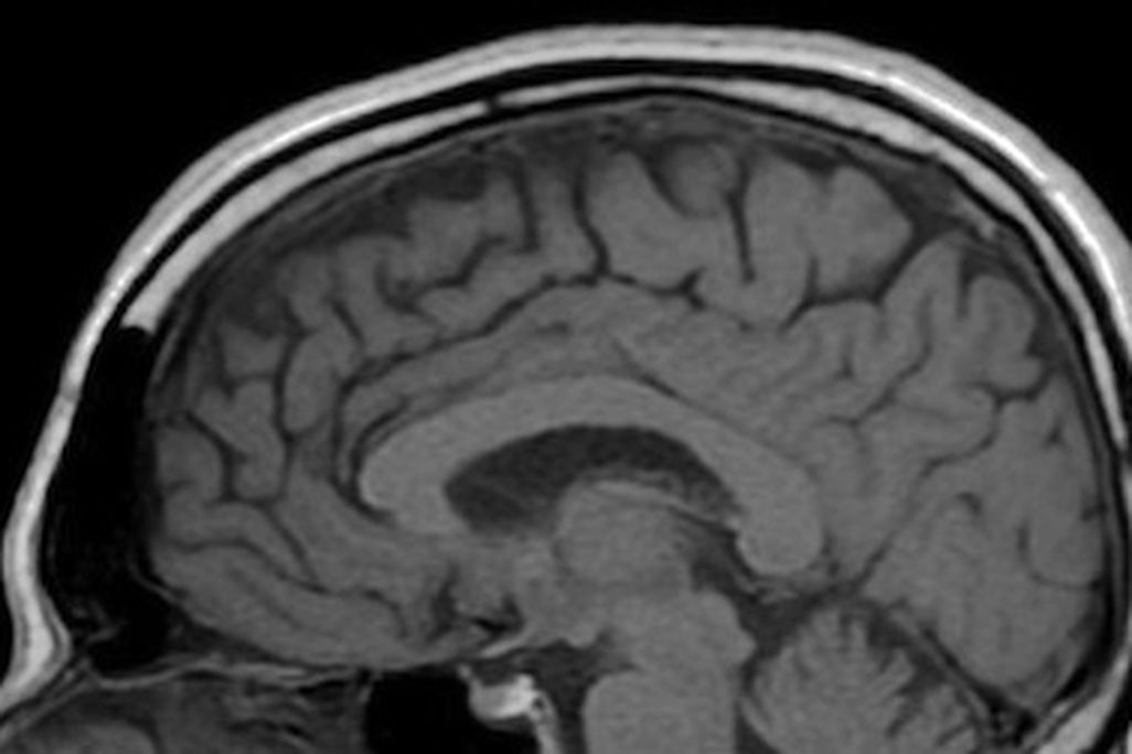 Researchers have found neurological abnormalities